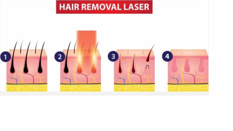 Tips for the Best Laser Hair Removal